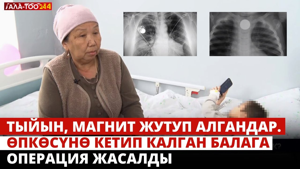 Тыйын, магнит жутуп алгандар. Өпкөсүнө кетип калган балага операция жасалды