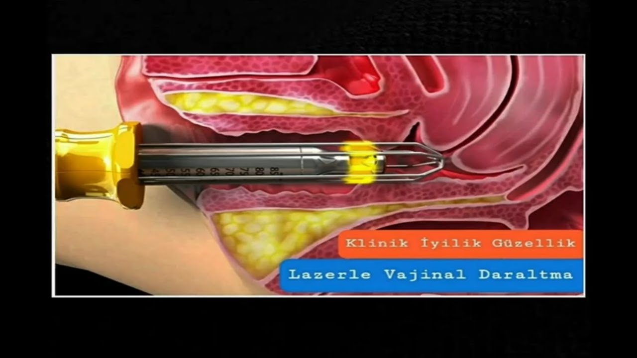 Lazerle vajina daraltma. Ağrısız acısız vajina daraltma.