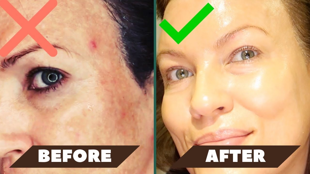 👉WATCH THIS to FADE DARK SPOTS.....in 7 days!  (no hydroquinone)