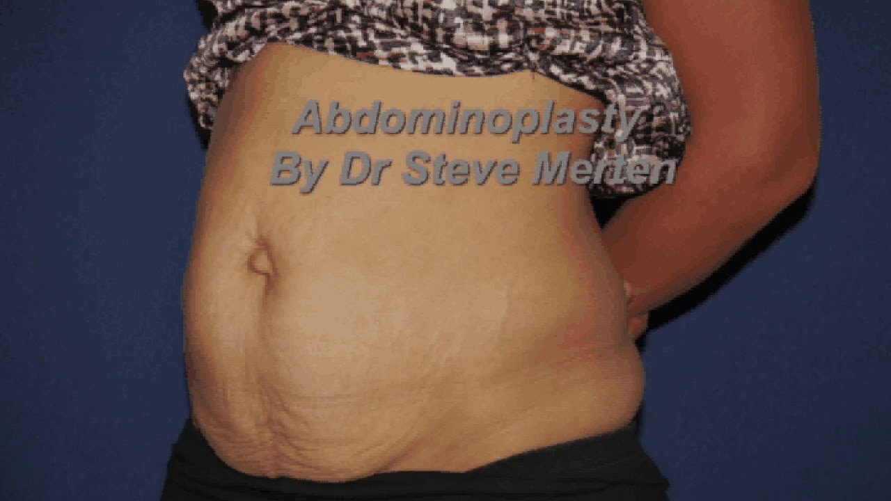 Abdominoplasty 