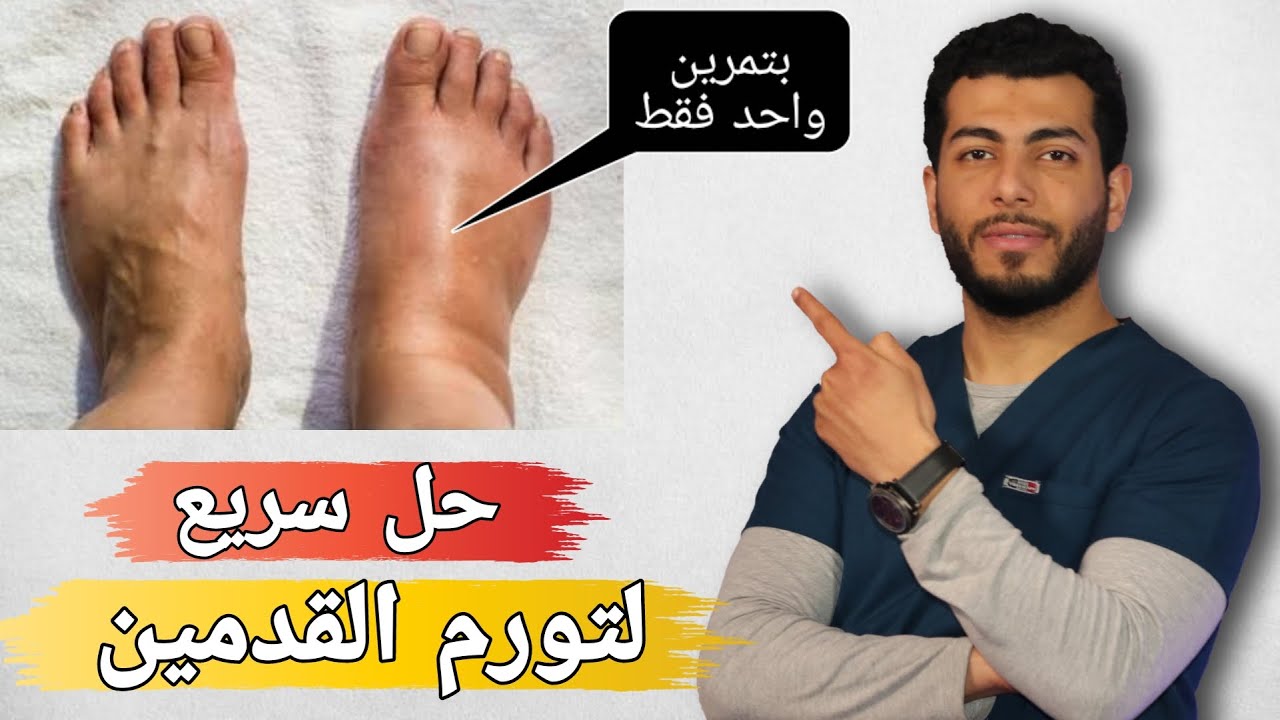 اسباب تورم القدمين واحتباس السوائل في الجسم وعلاجه بدون ادويه |اسباب وعلاج انتفاخ القدمين والساق