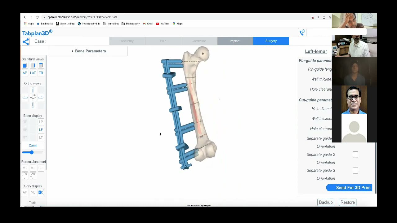 How multi-apical + multi-planar deformity was corrected and fixed with Rail Fixator using Tabplan3D