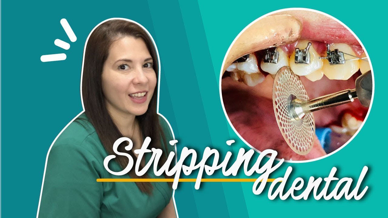¿Qué es el Stripping dental? | Joana Campolargo