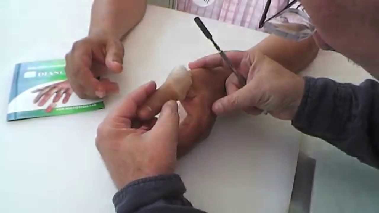 Protesis para dedo, finger prosthesis No 121