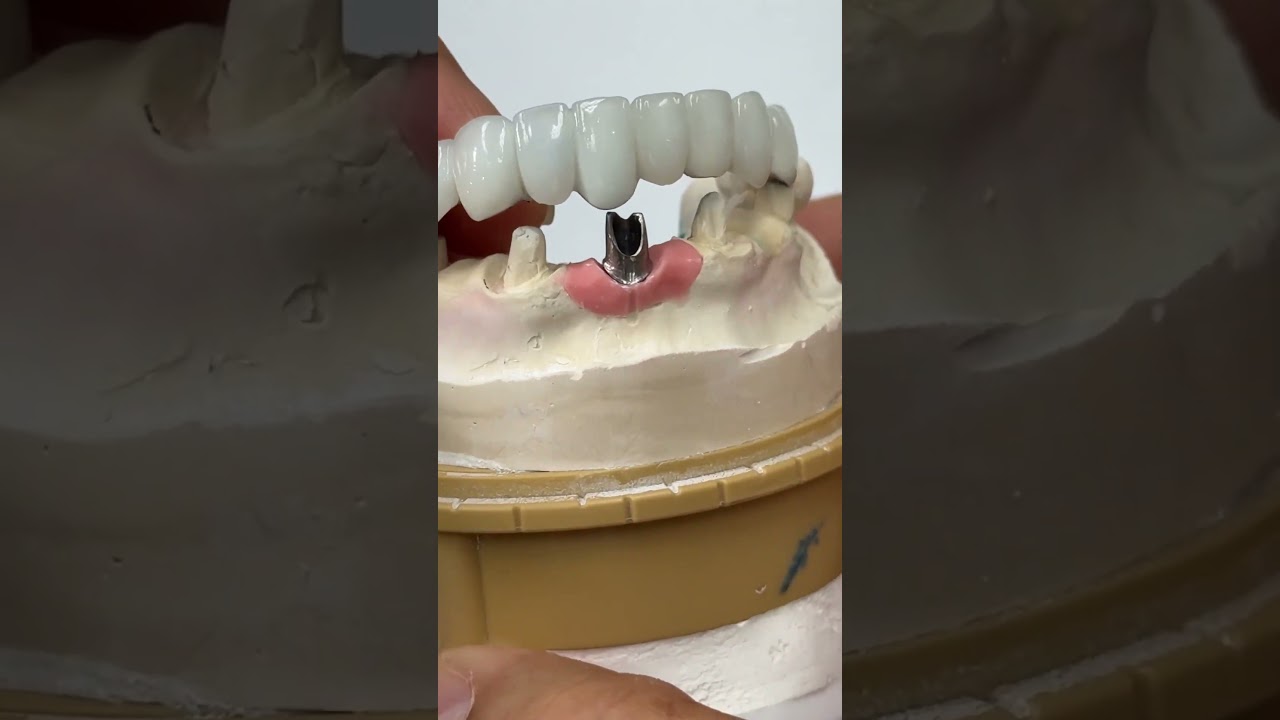 All in one metal ceramics!