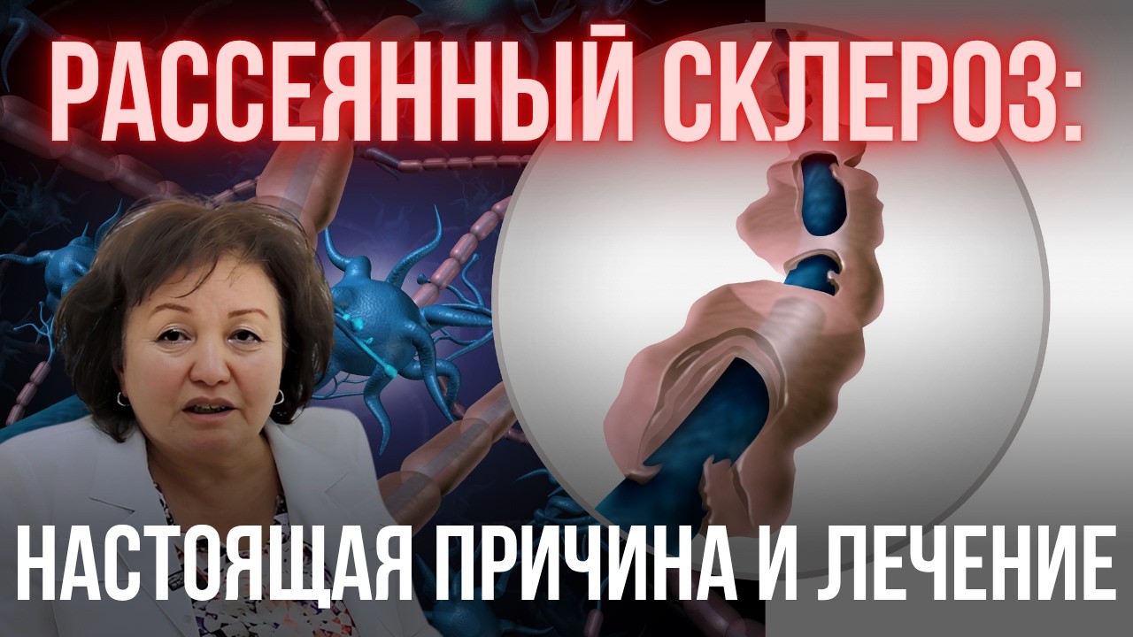 Рассеянный склероз: настоящая причина и лечение