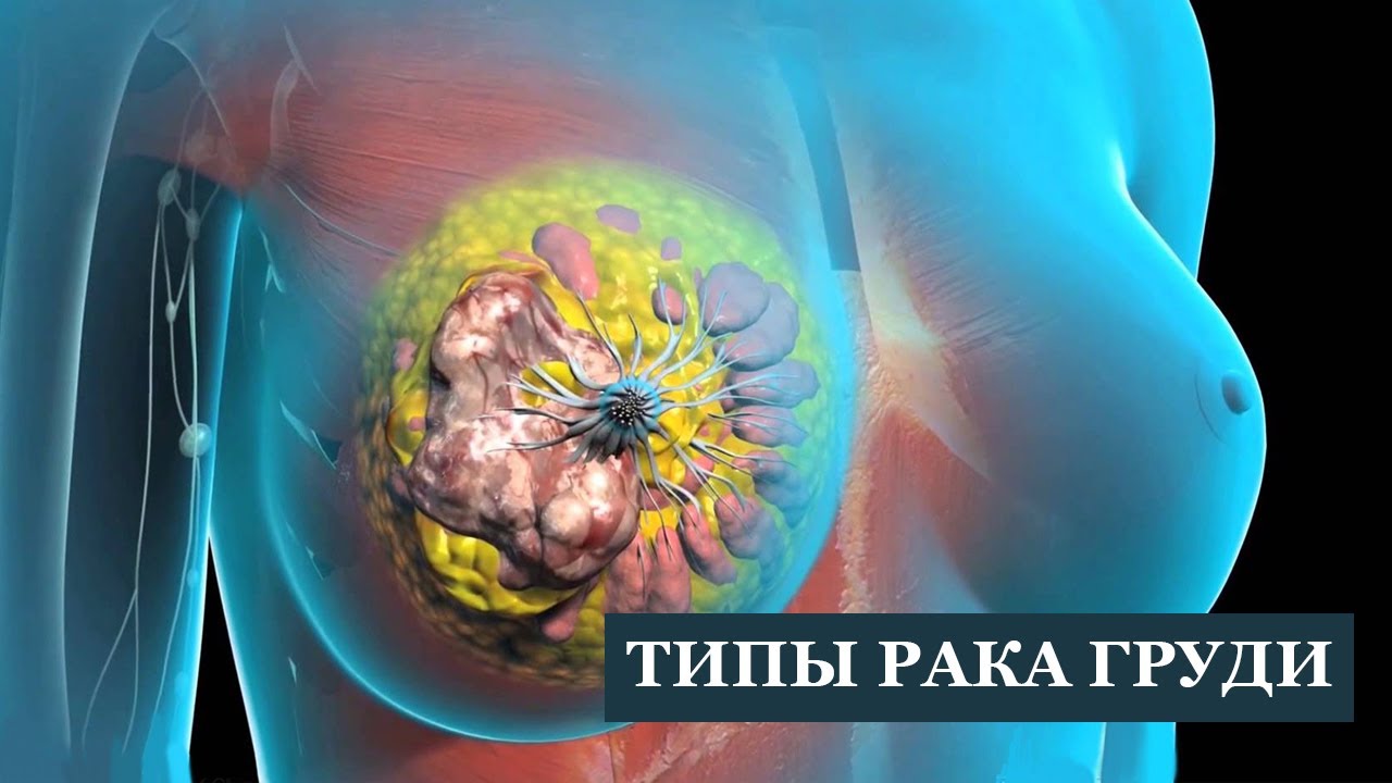 Типы рака груди. Как правильно лечить.