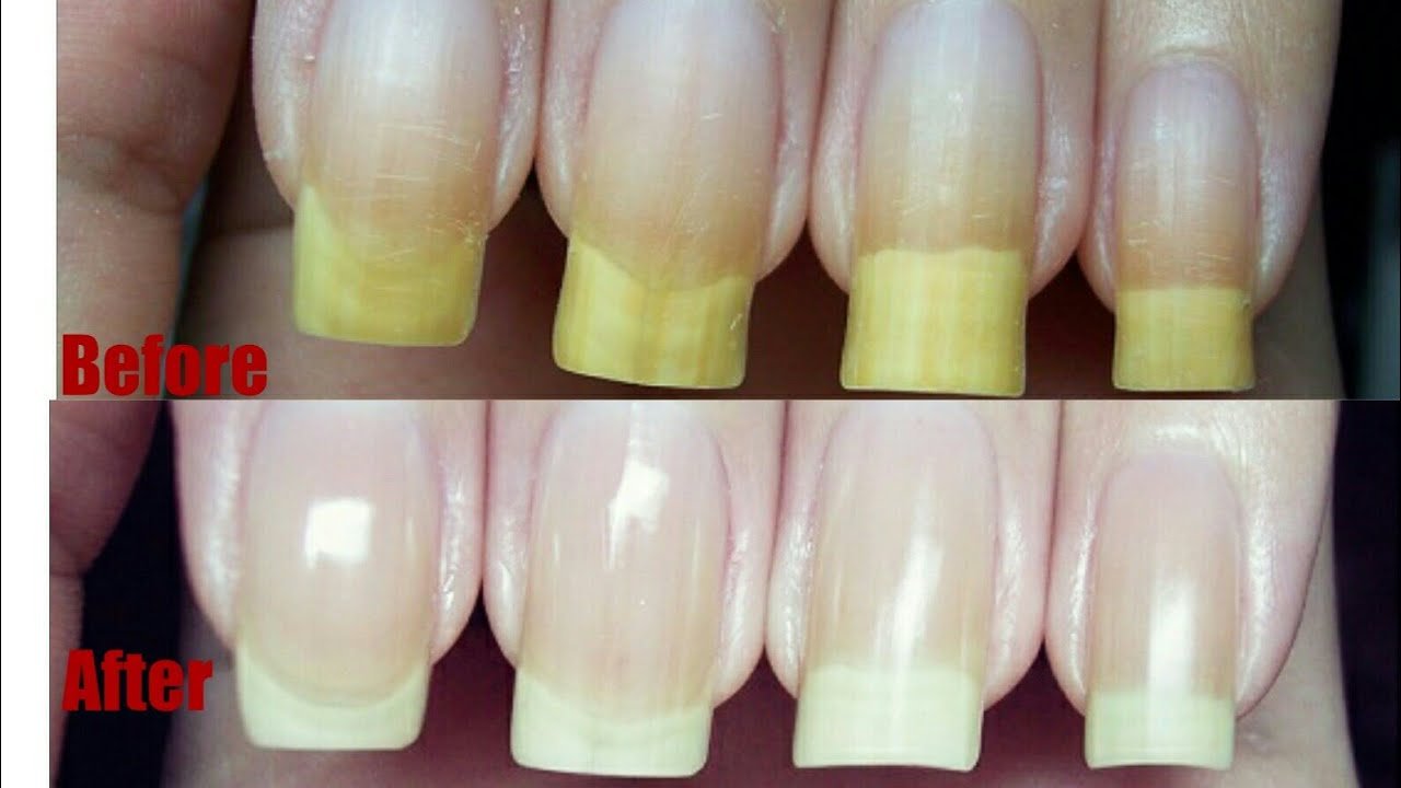 Bleach Your Discoloured Nails Instantly With This Simple Method.