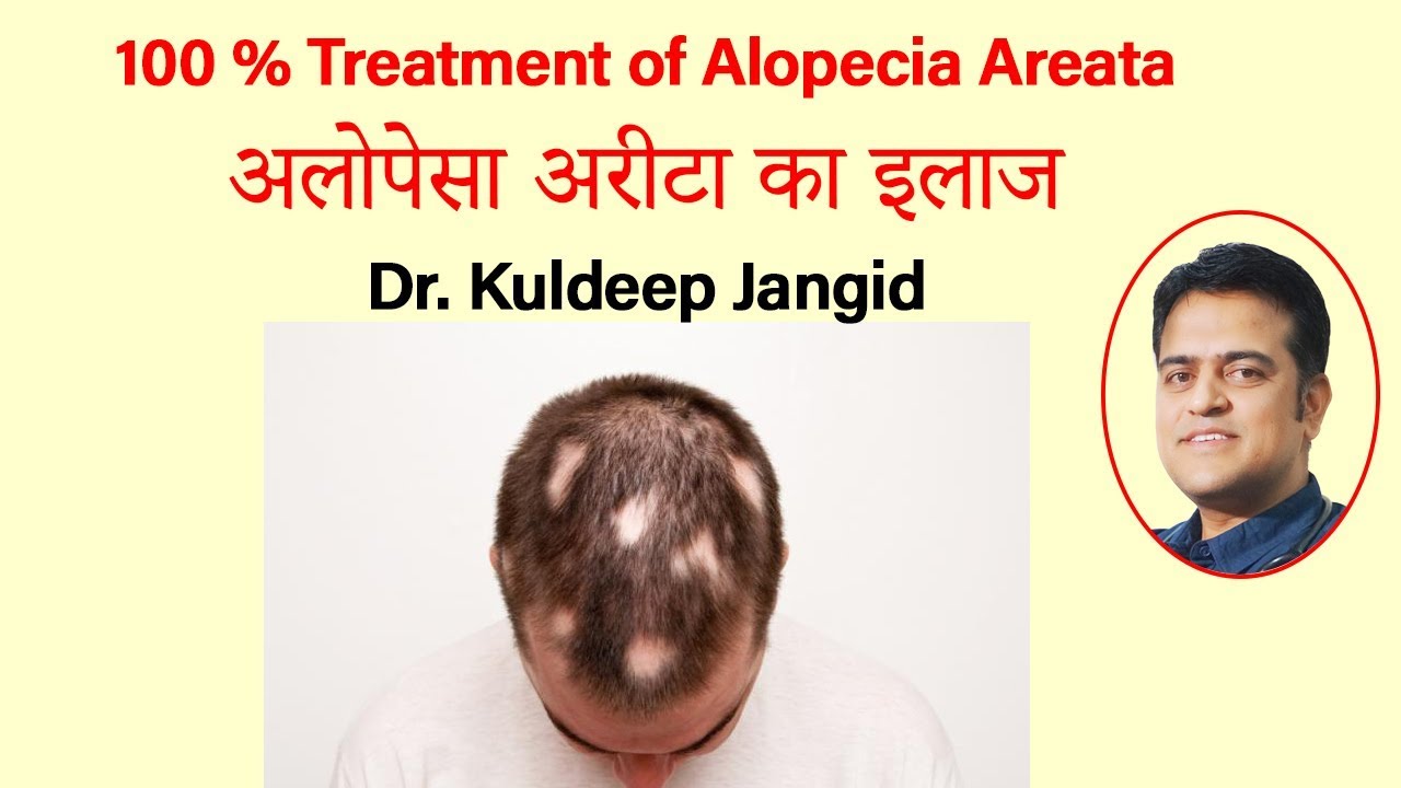 Best Treatment for Alopecia areata | Treatment of Hairfall in Patches | गंजापन का इलाज |