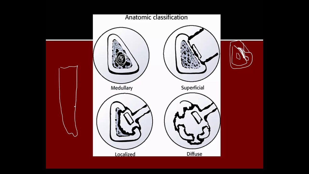 Chronic osteomyelitis