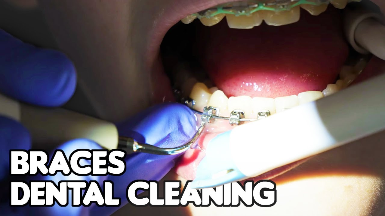 Teeth Cleaning With Braces At The Dentist