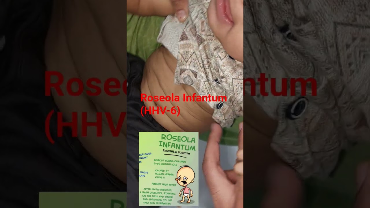 #Roseola Infantum #shorts #shortvideo #viral #ytshorts #yt #paediatrics #medicine #infection #skin