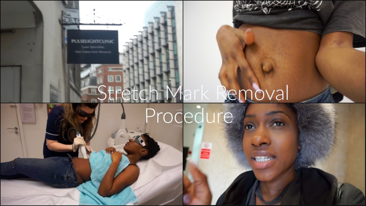 LASER STRETCH MARK Removal VLOG|| Pulse Light Clinic
