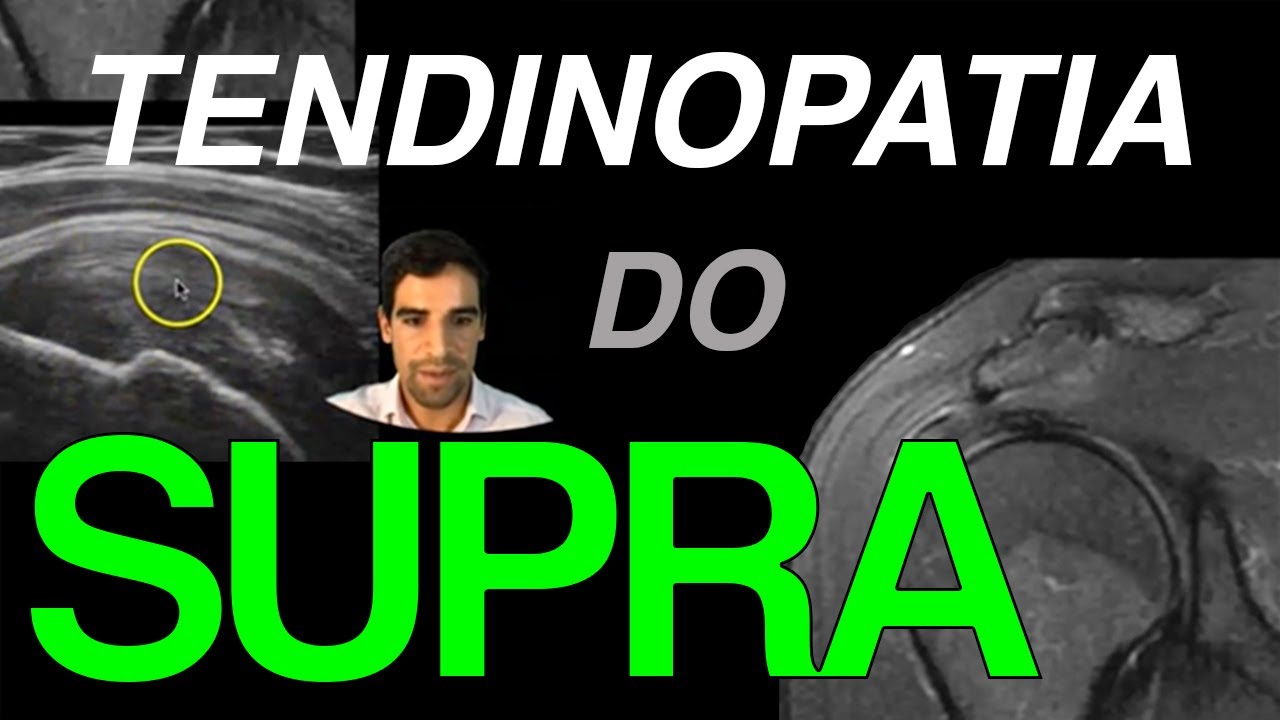 Tendinopatia do supraespinhal (USG e RM)