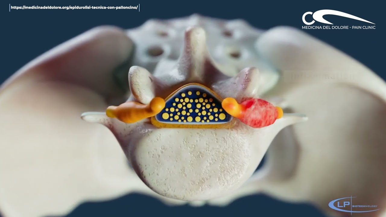 Epidurolisi con palloncino: Tecnica ZiNeu. Pain Clinic Medicina del Dolore