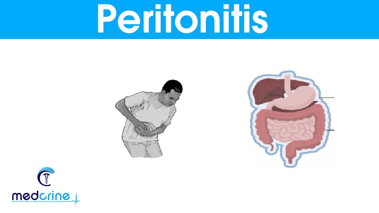 Peritonitis : causes, signs and symptoms and treatment