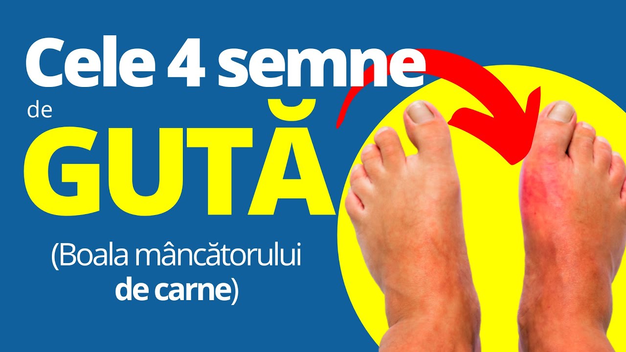 4 Simptome de GUTĂ, boala mâncătorului de carne