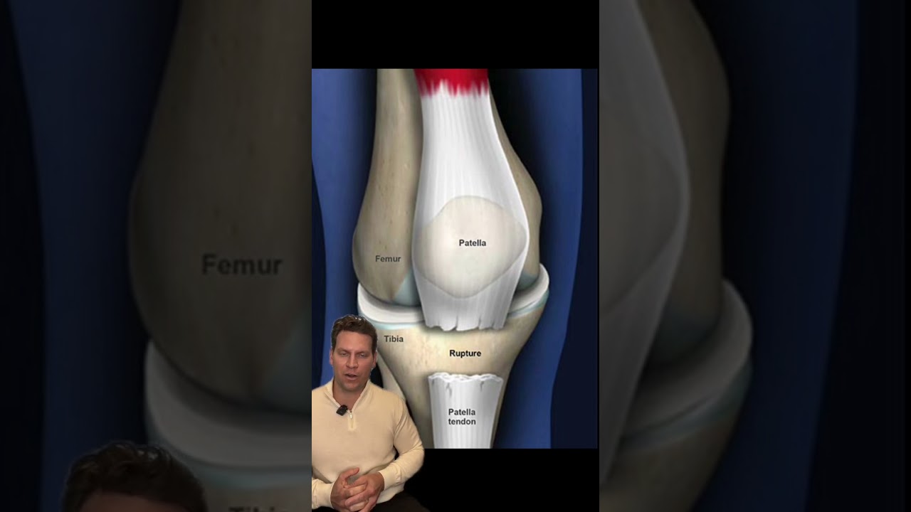 Patella Tendon Rupture: What You Need To Know!- Dr. Porter