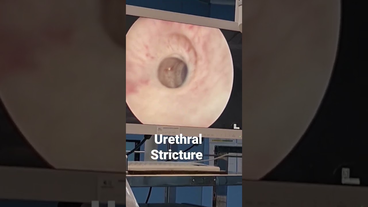 Urethral Stricture Endoscopic view. #stricture #poorflow #menshealth #boo