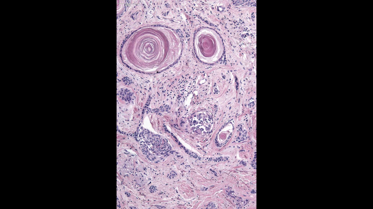 Malignant appendage tumors for Head & Neck Pathologists Part 1 McKee