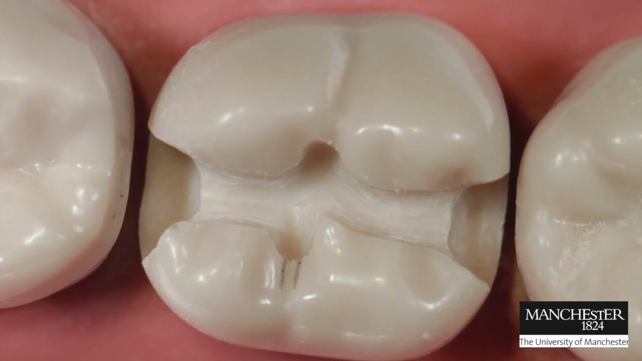 MOD amalgam preparation LL7