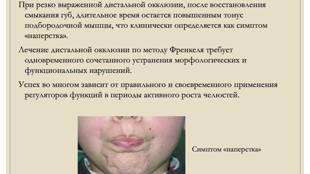 5.8в Ортодонтическое лечение аппаратами сочетанного действия