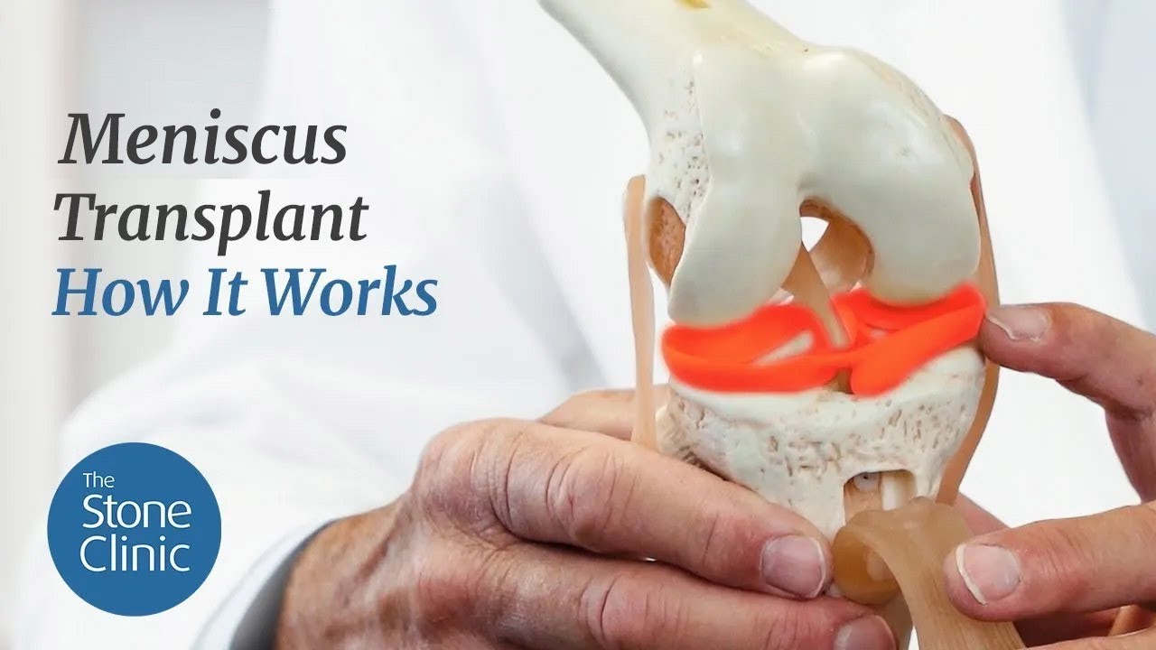 Meniscus Replacement - How it Works & What to Expect