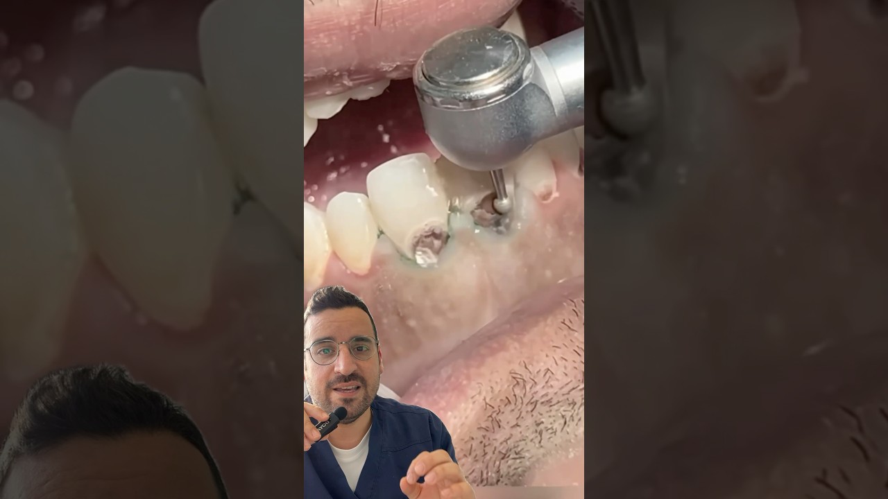 CARIE de l&rsquo;EXTR&Ecirc;ME : comment sauver des dents ab&icirc;m&eacute;s