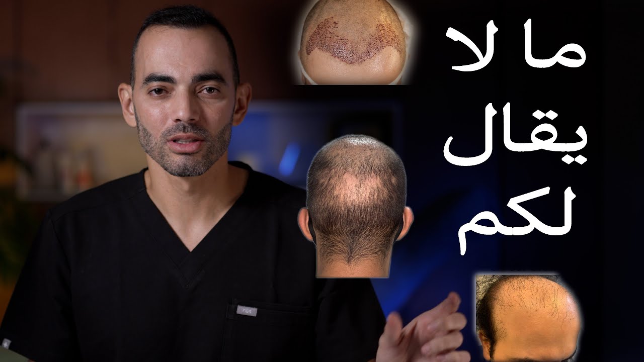 الجانب الأسود لزراعة الشعر