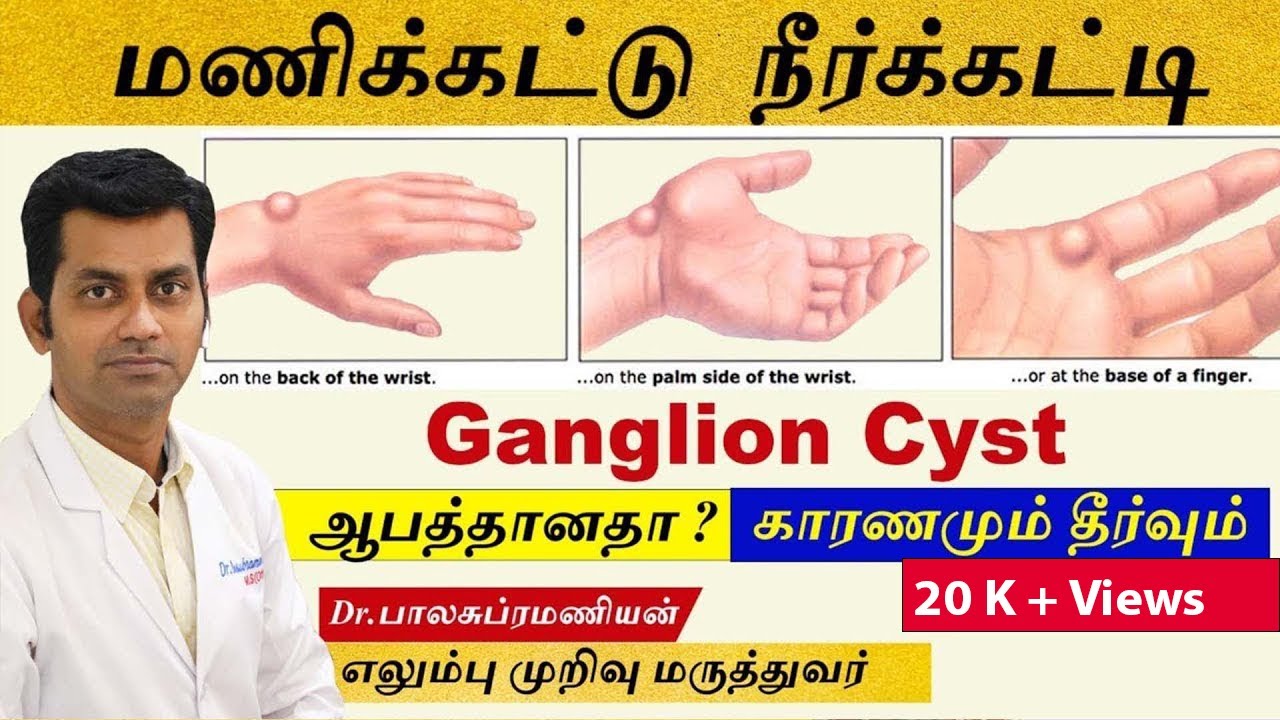 Ganglion : மணிக்கட்டு நீர்க்கட்டி ஆபத்தானதா காரணமும் தீர்வும் | Ganglion cyst treatment in tamil
