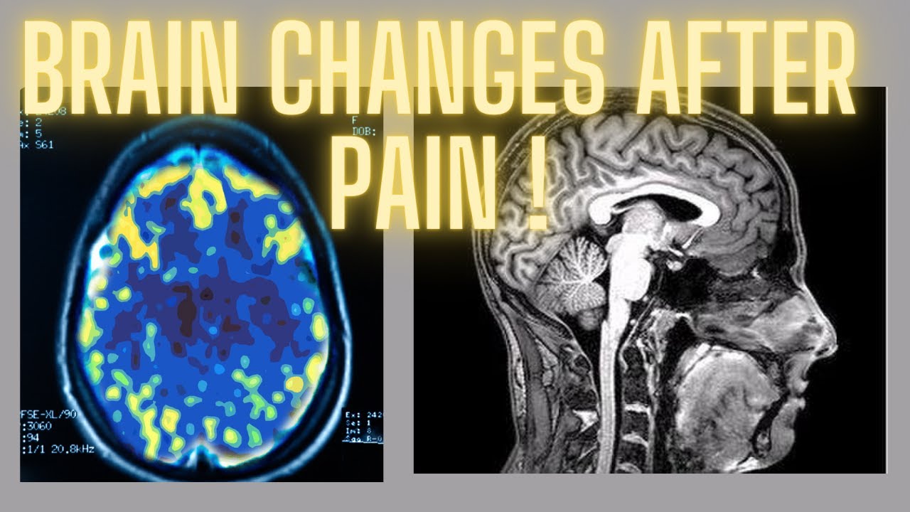 How chronic pain affects the gray matter of the brain and what it means for you
