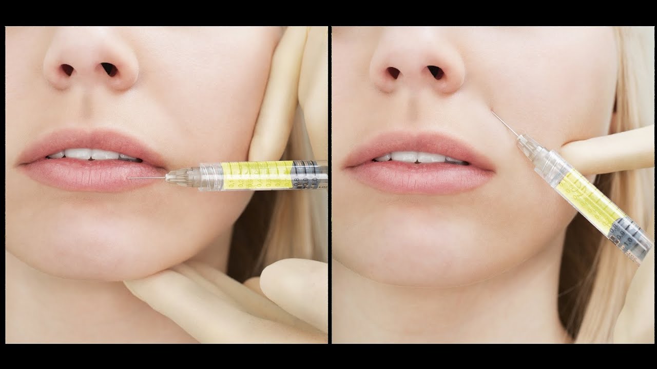 Bio-Filler & PRP tutorial