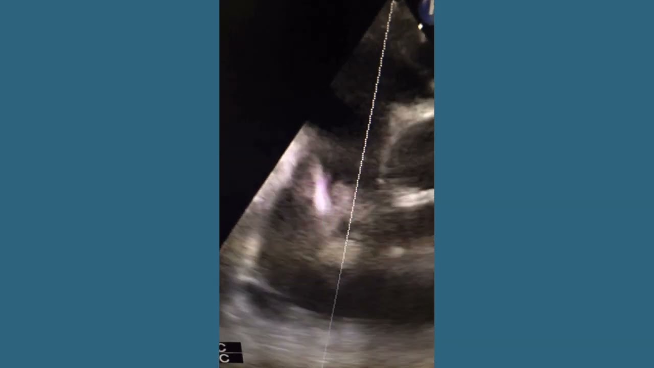 Large highly mobile Thrombus on RA pacing lead across the TV in diastole (3D TEE)