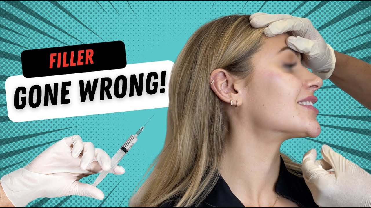 Filler Gone Wrong! Fixing Botched Cheek/Chin Filler