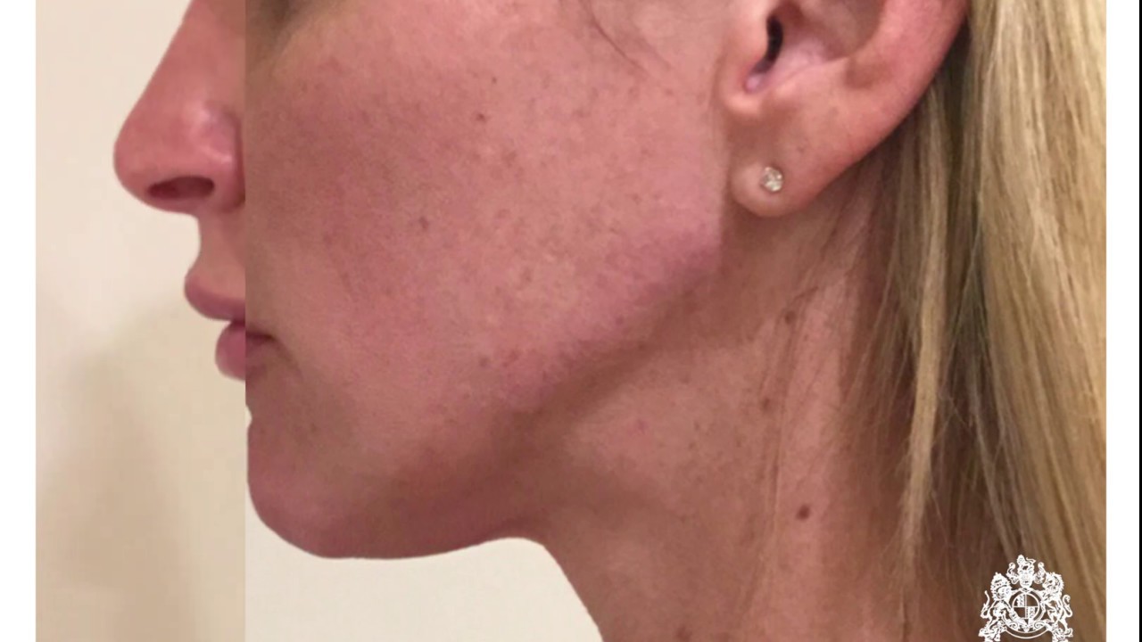 PROFOUND Microneedle RF - Before After 01 - Beverly Hills Plaza Medi Spa