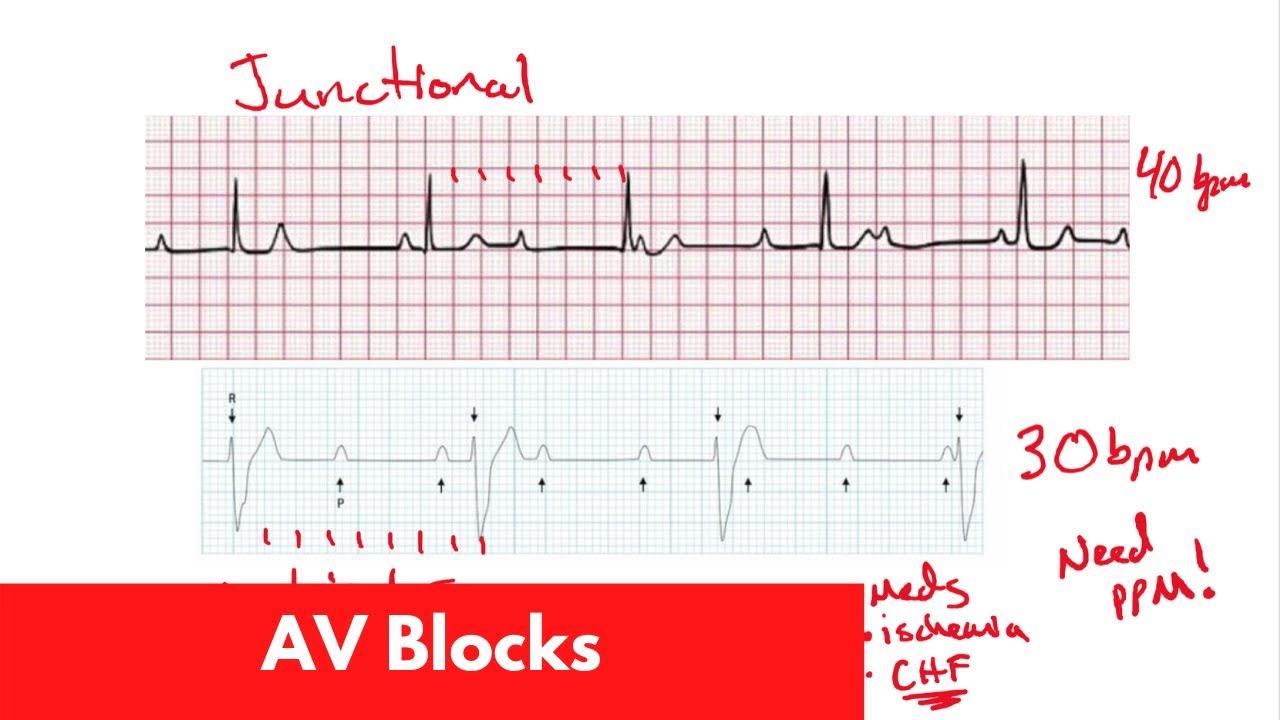 ECG Basics | AV Blocks | For DO, MD, NP, PA [Part 4]