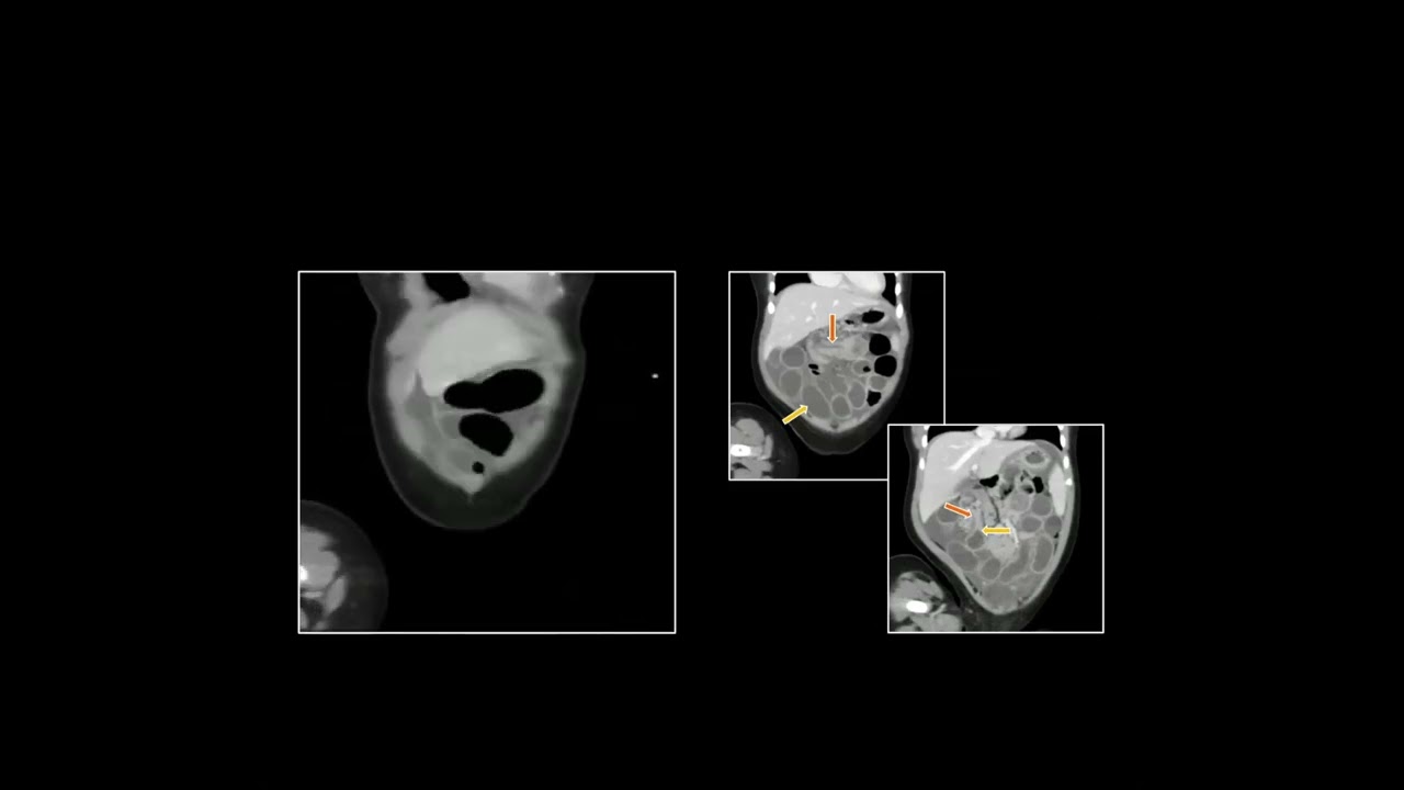 Pediatric Abdominal and Pelvic CT: Part 1 | Free Radiology CME