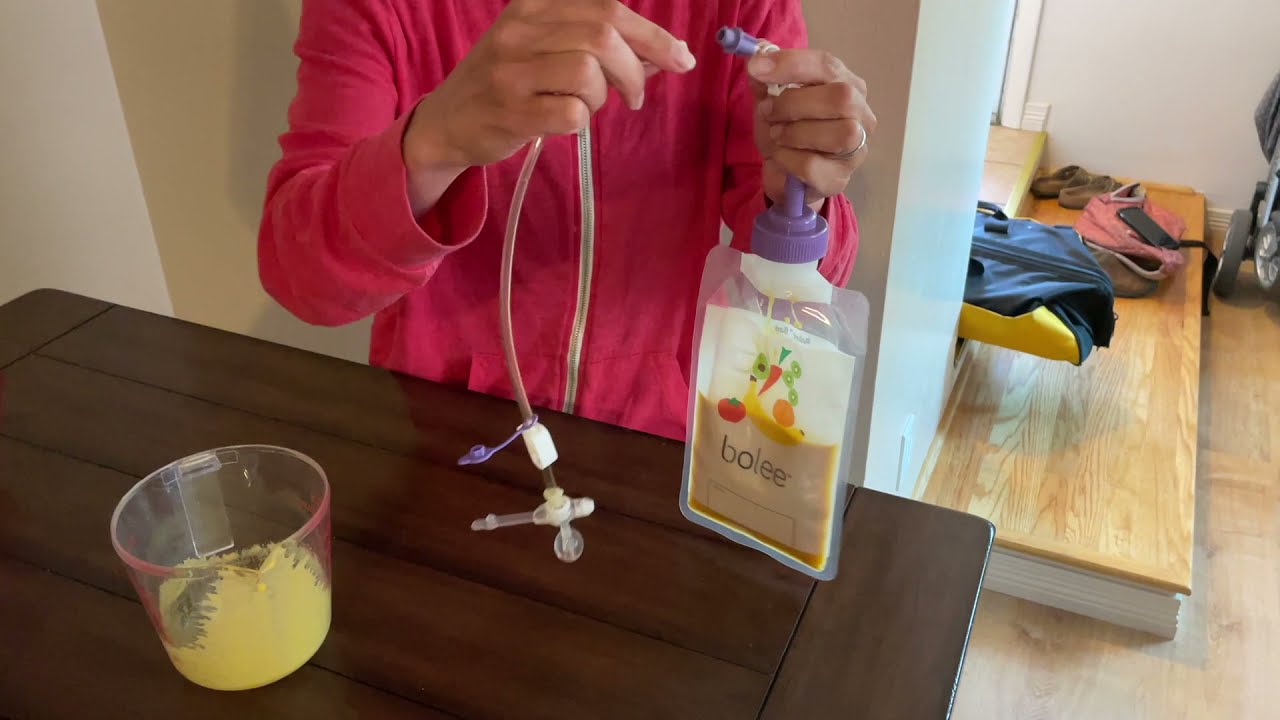 Tube Feeding with the Bolee Bag and Bolink Caps