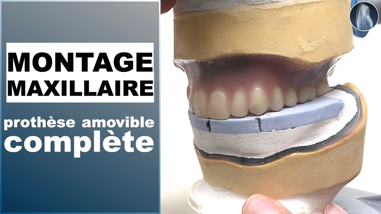 Apprenez à monter les dents maxillaires sur une table personnalisée. Guide pour prothèse amovible