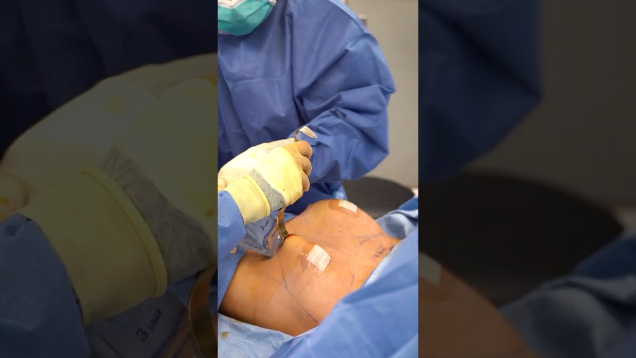 Breast Augmentation: See Real Post-Op Results! - Dr. Amir Arsalan | West End Plastic Surgery