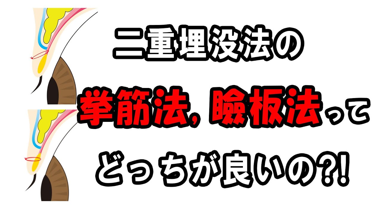 二重埋没法の挙筋法と瞼板法ってどっちが良いの？