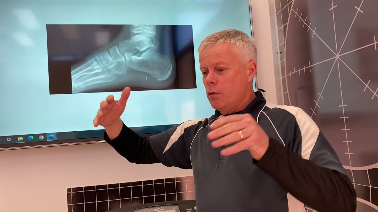 Treating Sever's Disease at Capital Podiatry