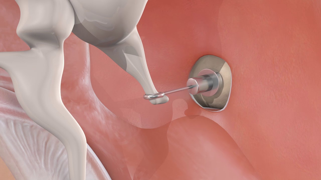 Stapedotomy
