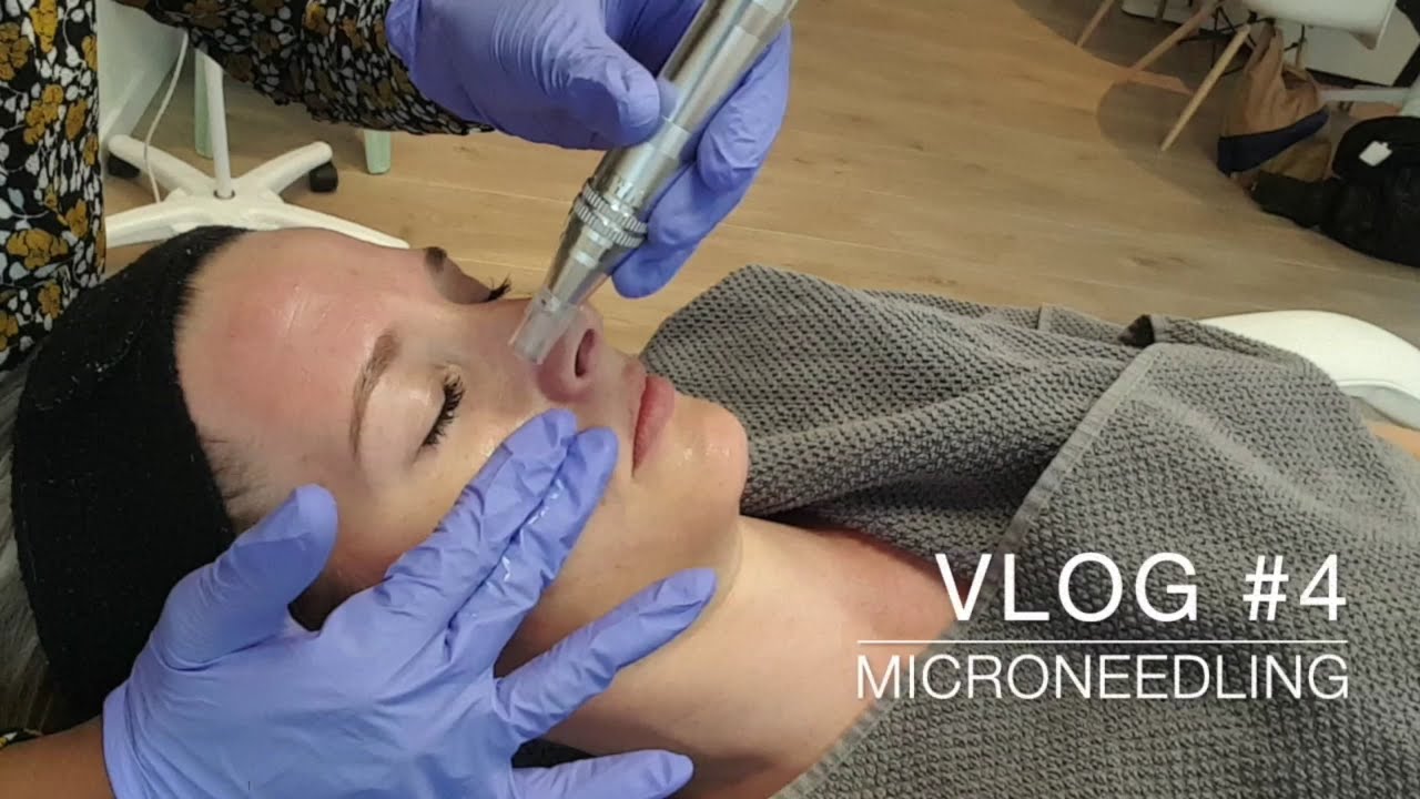 Vlog #4: Microneedling: Huidverbetering door kleine naaldjes