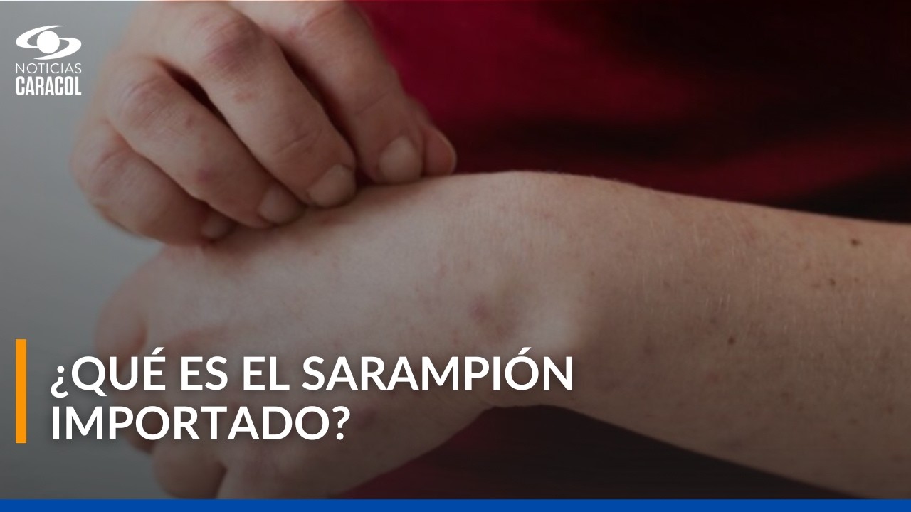 Detectan nuevo caso de sarampión importado en Bogotá: ¿qué se sabe al respecto?