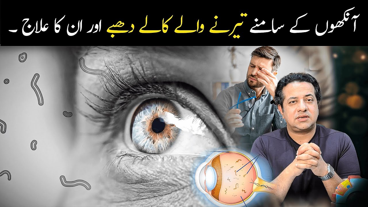 What Are Eye Floaters? Causes, Treatment & Prevention | Urdu Hindi Guide