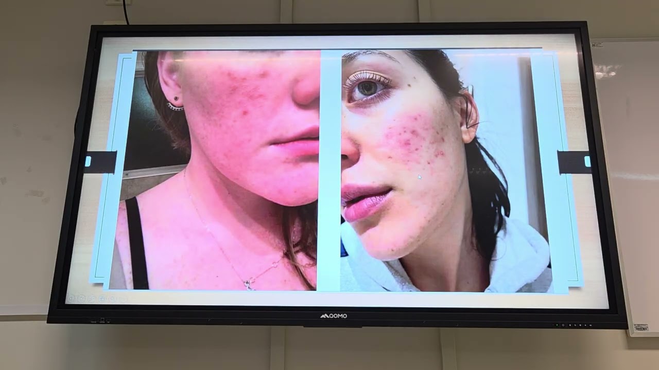 CLASE 1.5 ROSÁCEA《 DERMATOLOGIA 》
