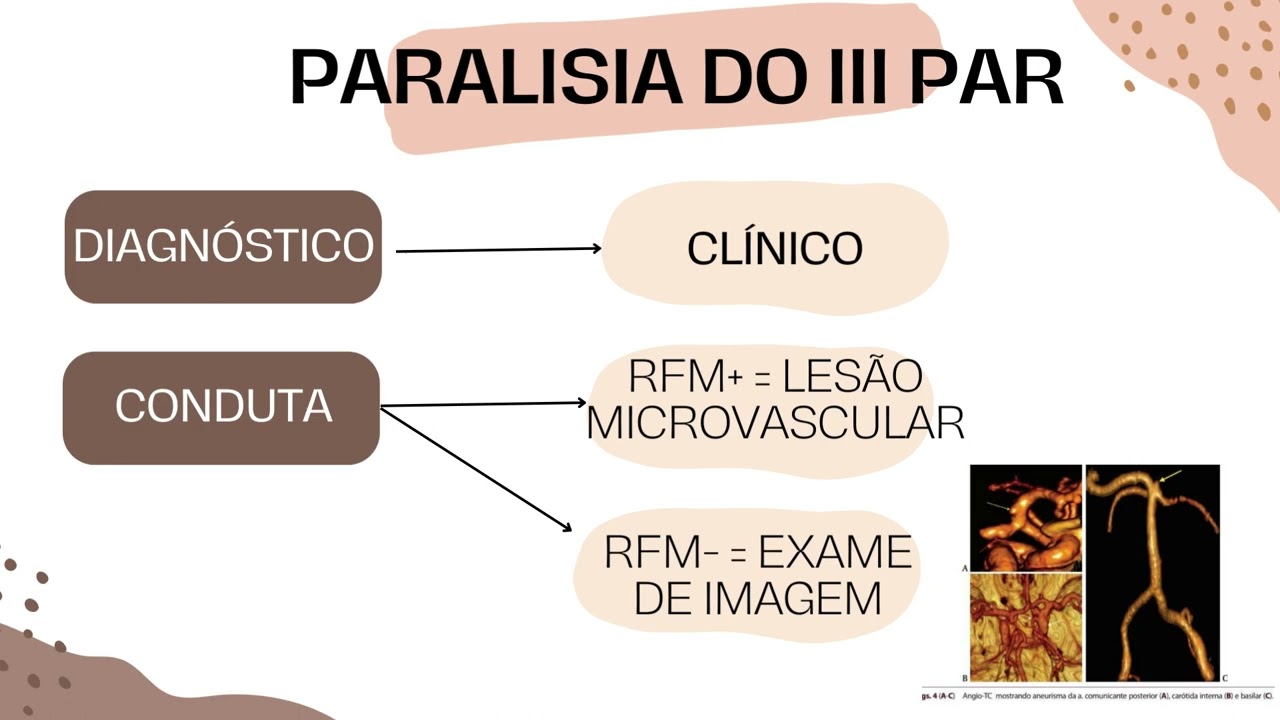 AULA 9 - programa estrabismo - PARALISIA DO III E DO VI PAR CRANIANO