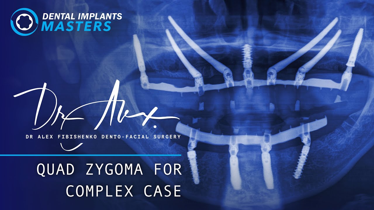 Complex Full Arch Cases | Plan and Recap - Episode 4