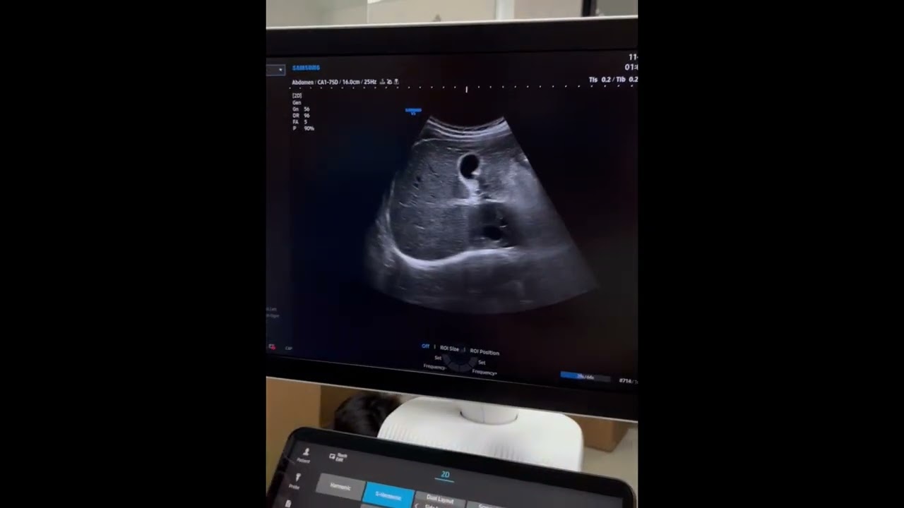 Thế hệ mới của SAMSUNG ULTRASOUND: #SAMSUNG #V5